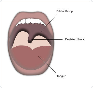 uvula